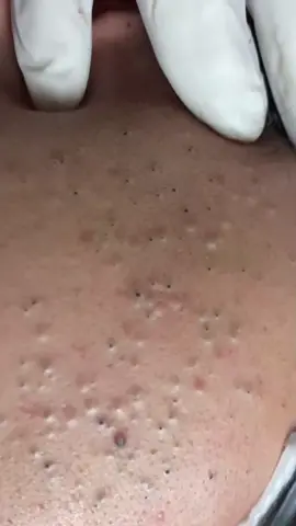 #cravos #espinhas #pimple #satisfatório