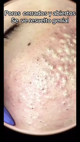 #Extracción #poros #granos#pelo #espinillas #limpiezafacial #acne #tratamientos 