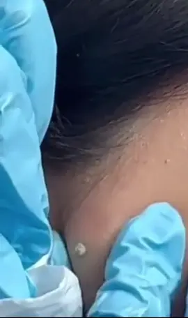 #brufoli #cravos #blackhead #zit #pimples_brufoli_ #popper #pimple #acne #pimples_brufoli #popping #zits #asmr #pimples #pimplepop #granos #granosyespinillas 