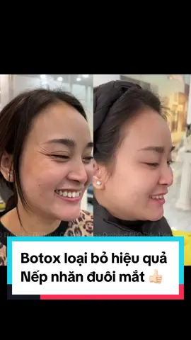 Hiệu quả của botox khi sử dụng để loại bỏ nếp nhăn đuôi mắt - đem lại sự trẻ trung, đầy đặn cho khuôn mặt 🥰#filler #viral #BeautyTok #trending #botox  #orchard 