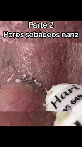 #Extracción #poros #granos#pelo #espinillas #limpiezafacial #acne #tratamientos 