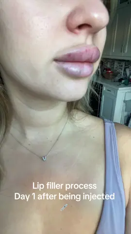Half a syringe 💉👄 trust the  progress 👀  . ##lips##filler##lipfiller##progress
