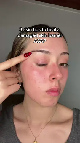 spillin some teaa on healing ur face cause we’ve all been there atleast once where we’ve fried our face off using something we shouldnt have lmao - hope these come in clutchhh #congestedpores #cloggedpores #sebaceousfliaments #oilypores #anuabhatoner #anuapartner #anua 