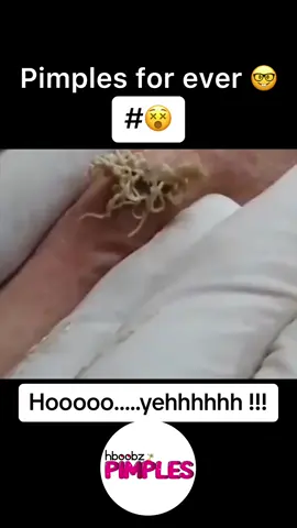 #pimple #medical #horror #blackhead #bigpimple #pimpleremoval #disgusting #pimplepop #cystexplosion #squeeze #squeezeyuk #skincare #acnetreatment #acne #pimples #satisfying #abscess #verysatisfying #whiteheads #cyst 