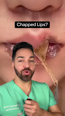 Chapped lip SZN #dermatologist 