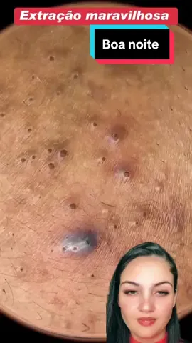 Bora de terapia #limpezasatisfatoria #terapia #reagindo #removal #satisfatório #extractions #cravos 