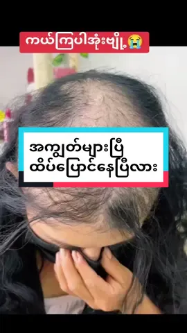 #ဆံပင်ထိပ်ကွက်သူများအတွက် #mayသဘာဝကြိတ်မှန်ဆီပင်ရင်း #Mayသဘာဝကြိတ်မှန်ရွက်ခေါင်းလျော်ရည် #mayသဘာဝကြိတ်မှန်ဆီ #ရောက်ချင်တဲ့နေရာရောက်👌 #တွေးပြီးမှတင်ပါ #onlineshopping #treatment #foryoupage #tiktokuni #Tiktokmarketing #tiktokmarketingplace #ဆံပင်အကျွတ်သက်သာချင်တဲ့သူတွေရှိလား 