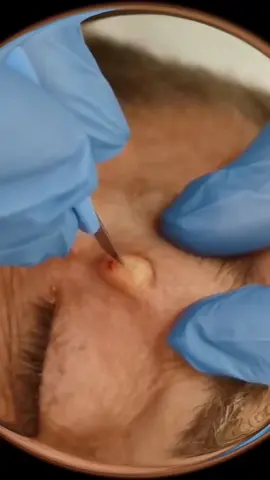 Akne quetschen #pimple #cyst #blackhead #pimplepop #pimples #squeeze #squeezeyuk #acneremoval #acnetreatment #satisfying #foryou #acne 