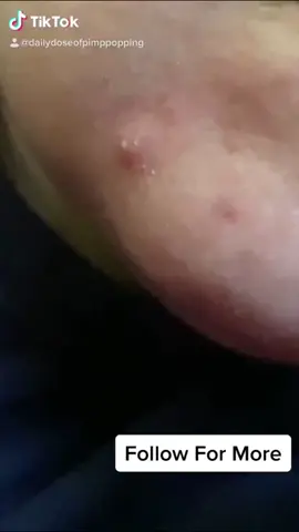 Cheeky pop (enjoy the pun) #pimple #fyp #satisfying #pop  