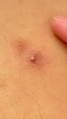 Merry christmas #pimple #fyp #satisfying #pop 