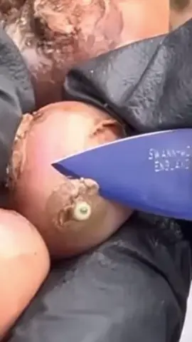 Jiggers removal #jiggers #jiggersremoved #satisfying #satisfyingcleaning #clean #removal #foot #footcare #foryou #parasite #us #africa #cleaning #feetcare #CleanTok #boutous #asmr #feet #pimple #satisfyingvideo 