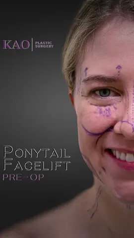 For me, beautification is the essence of facial aesthetic rejuvenation. It all starts with pre-operative evaluation that paves the way for such precise surgical planning. We evaluate every angle, every wish, and every concern because everything I do is customized to the vision I see for the patient. Only after a deep and thorough understanding of their aesthetics, goals, desires and fears, will we proceed to this day of operation. We carefully review the surgical plan and the markings reflecting that plan are created with accuracy and precision. Beware of surgeons who make untidy markings! #ponytailfacelift #beautification #kaoplasticsurgery 