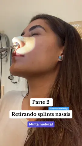 Parte 2 - mais meleca! Retirada de Splints nasais. #rinoplastia #septorhinoplasty #septoplastia #estetica #cirurgiaplastica #cirurgia #splint #retirada #alivio #celebrardemulherparamulher 