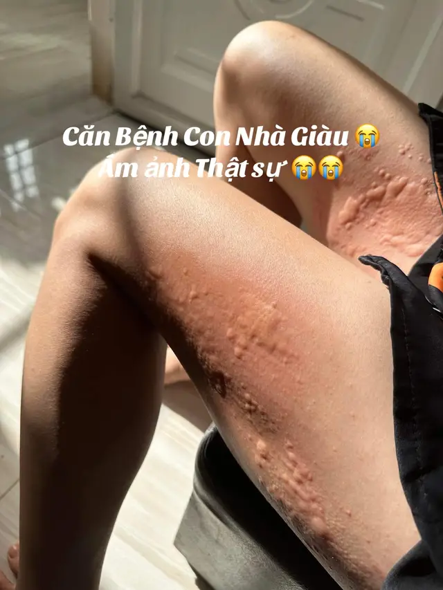 Căn bệnh con nhà Giàu 😭chỉ có ai bị mới biết cảm giác nó khổ sở thế nào 😭bất lực tưởng chừng như sống với nó cả đời thì may mắn cuói cùng cung. trị dc. mừng rớt nước mắt #mềday #mềdaysausinh 