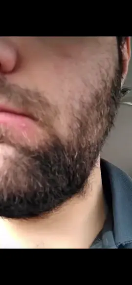 #cravos #brufoli #blackhead #zit #pimples_brufoli_ #popper #pimple #acne #pimples_brufoli #popping #zits #asmr #pimples #pimplepop #granosyespinillas #granos 