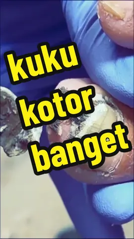 bersihin kuku yg kotornya kebangetan dengan aroma aroma candu yg bkin ketagihan #ingrowntoenail #cantegan #satisfying #fyp #longervideos #viralvideos 