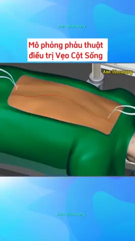 Mô phỏng phẫu thuật Vẹo Cột Sống.#kienthuc #yte #ykhoa #phauthuat #veocotsong 