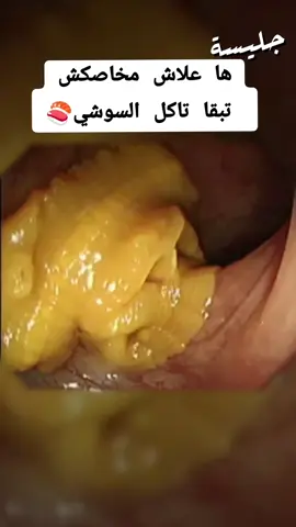 ها علاش مخاصكش تبقى تاكل السوشي  #أضرار_السوشي #هاعلاش_خاصك_تفادا_السوشي #الدودة_الشريطية #sushi #sushilover #sushimonsters #aliments_asiatiques 