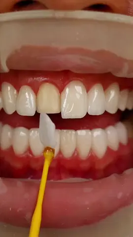 Ultra thin natural emax veneers