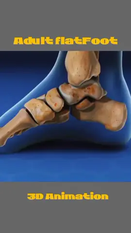Flat foot surgery Medical animation #flatfoot #flatfootsurgery #flatfooted #flatfoottherapy #medicalanimation #footsurgery #footpain #footpaintreatment #footballedit #foryou #foryoupage