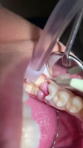 Broken Tooth😪 #fyp #teeth #brokentooth #dentistry #reactions 