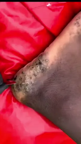 Jiggers removal #jiggers #jiggersremoved #satisfying #satisfyingcleaning #clean #removal #foot #footcare #foryou #parasite #us #africa #cleaning #feetcare #CleanTok #boutous #asmr #feet #pimple #satisfyingvideo 