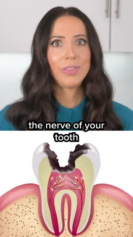 Lots of people assume that a toothache is the first sign of a cavity. Unfortunately, it’s not that simple. Although SOME cavities can and eventually may cause pain, it is more common to feel nothing at all. So if your dentist says you have a cavity that needs a filling, then get the filling BEFORE it starts giving you problems and BEFORE you have any pain! Not only will you save yourself from some major discomfort, but you will also save money in the long run because fillings are much more affordable than root canals and crowns (because y’all know after a root canal comes a crown, which adds to the total cost of treatment)! For more information about how to prevent cavities, watch my latest video on YouTube.com/TeethTalk ☮️❤️🦷 #cavities #dentist #dentalhygienist 