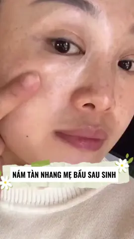 🌺️Làn Da Trắng Mịn - Giải Pháp Hoàn Hảo Đối Phó Với Nám,Tàn nhang 