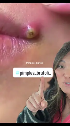 #duet with @Pimples Brufoli Zits Acne #pimples_brufoli_  my cat trotted up -he doesnt mind pimples… #drpimplepopper