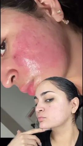well well well👀 my results using the @LYMA Laser. Buy the laser now and get their full skincare range for free (worth $525)  #acnejourney #athomelaser #lyma #beautydevices