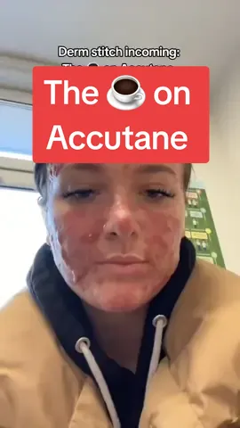 #stitch with @Courtney Leigh Spilling the tea on Accutane! Here's a brief overview on Accutane from a dermatologist perspective. Let me know what questions you have! #accutanejourney #accutanecheck #dermatologist #theteaonaccutane  #accutane #isotretinoin #acne #acnescars #whatisaccutane 