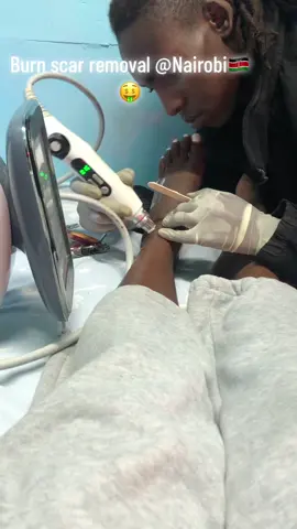 #scarremovaltreatment #scarremoval #microneedling #microneedlingtherapy #tiktokkenya🇰🇪 #foryou #nairobitiktokers #foryoupage #fypシ゚viral #kenyantiktok🇰🇪 #fypシ #fypシ゚viral #fyp located at The Bazaar plaza 10th floor 0757205259🇰🇪