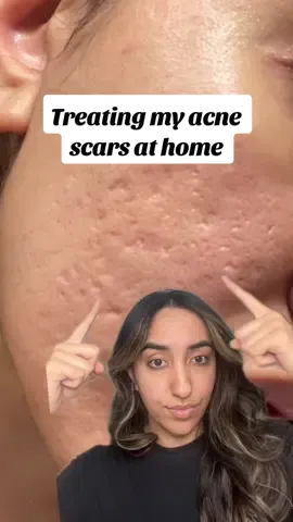 Treating my acne scars at home #acnescartreatment #banisher #microneedling #beauty @BANISH 