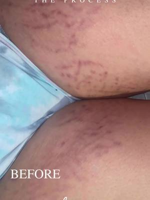 Aquí tienes un antes y después de estrías. Este procedimiento en particular también fue sin tinta! Descubre cómo lograr resultados increíbles sin necesidad de tinta. Contáctanos para más detalles! ✨  #scartransformation #redneutralization #beforeandafter #scarcamouflage #stretchmarkcamouflage #permanenttattoo #dallasparamedicaltattoo #houstonparamedicaltattoo #repairstretchmarks #redstretchmarks 