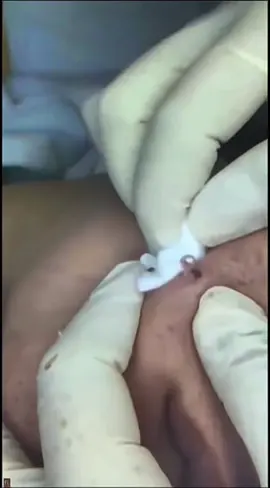 #cravos #brufoli #blackhead #zit #pimples_brufoli_ #popper #pimple #acne #pimples_brufoli #popper #popping 
