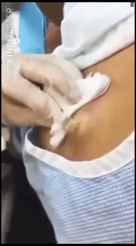 #cravos #brufoli #blackhead #zit #pimples_brufoli_ #popper #pimple #acne #pimples_brufoli #popping #zits #asmr #pimples #pimplepop #granosyespinillas #granos 