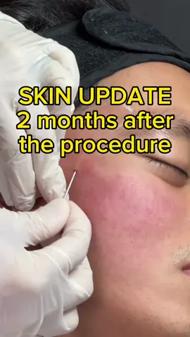 2 months after the procedure update + altoskin dermatology promo #acnescar #acnescarrevision #fyp #co2laser #fractionalco2laser #subcision 