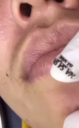 #cravos #brufoli #blackhead #zit #pimples_brufoli_ #popper #pimple #acne #pimples_brufoli #popping #zits #asmr #pimples #pimplepop #granosyespinillas #granos 