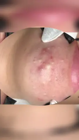 #blackheads #blackhead #pimple #pimples #pimple #pimplepoppersatisfying 