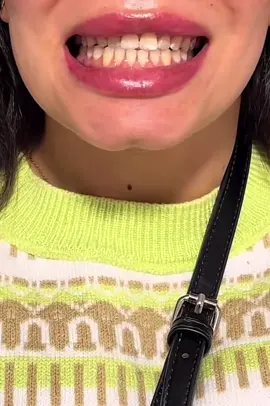 #snap_on_smile #فينير_متحرك #fyp #fypage #lab #zirconia #veneers_smile 