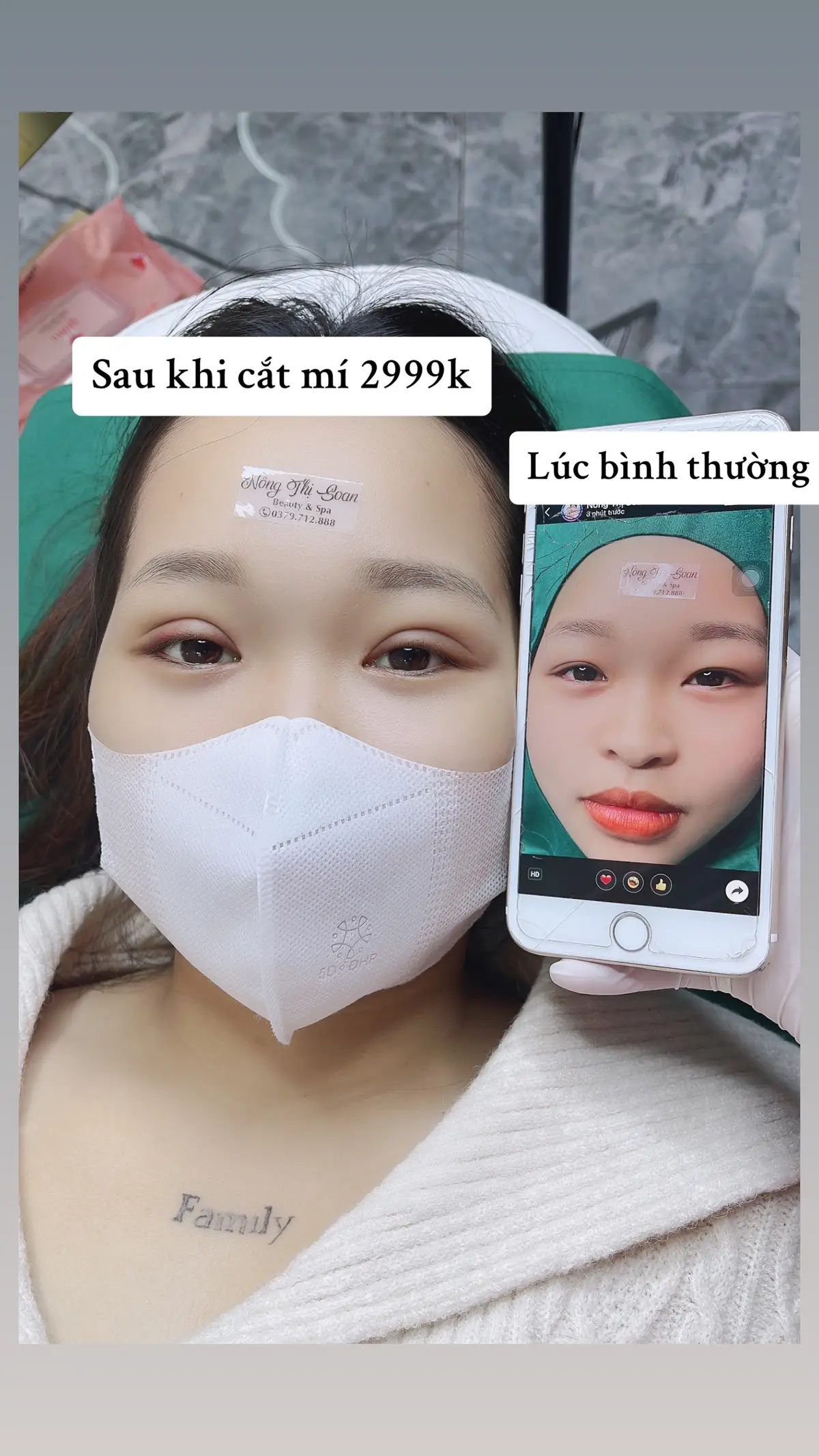 Mắt 1 mí, mí sụp, mí lót. Cắt mí chỉ từ 2999k không đau, không bầm tím. #catmibacgiang #pttm #catmidep #catmi 
