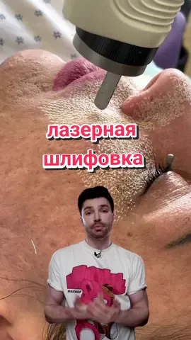 Лазерная шлифовка. Хочешь?😏 #бьютиголик #бьютиблог 
