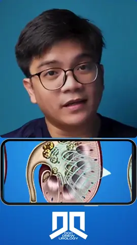 Recurrence of kidney stones #docdrew #urologist #shockwave #kidneystones #eswl