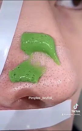 #cravos #brufoli #blackhead #zit #pimples_brufoli_ #popping #asmr #zits #pimples #granos #acne #popper #pimple #pimples_brufoli #granosyespinillas #pimplepop 