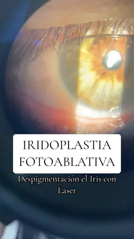Otro caso exitoso 🧿 #iridoplastia #Laser #peru #lima #ophthalmology #cambiodecolordeojos 