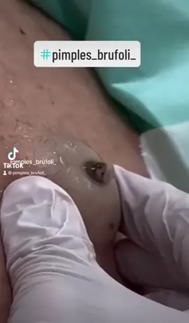 #cravos #brufoli #blackhead #zit #pimples_brufoli_ #popping #asmr #zits #pimples #granos #acne #popper #pimple #pimples_brufoli #granosyespinillas #pimplepop 
