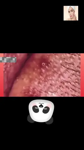 #squeeze  #squeezeyuk  #acne  #pimple  #pimplepop  #blackhead  #satisfying  #foryoupage