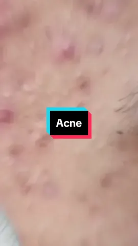 Help acne without pills?! #acne #natural #LifeHack #skincare #doctor 