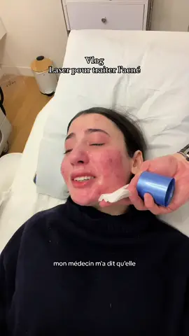 Petit vlog spécial Acné , Espérons que cette fois-ci soit la bonne !!💖💅    #Vlog #minivlog #laser #laseracne #acne #traitementacne #rougeurs #cicatriceacné #laservisage #soinvisage #soindelapeau #unejourneeavecmoi 