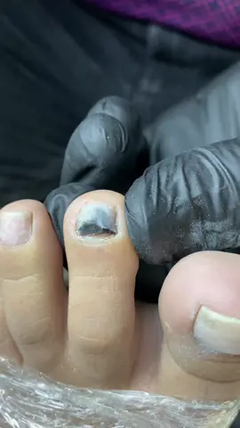 Traumatismo en la uña natural 😨 #pedicure #limpiezadepies #pedicuraprofunda #podologia #pedicura #uñaincarnada #nailstutorial 